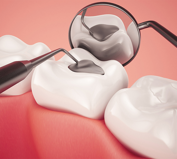 Dental mirror and explorer tools positioned on pink gum model against coral background.