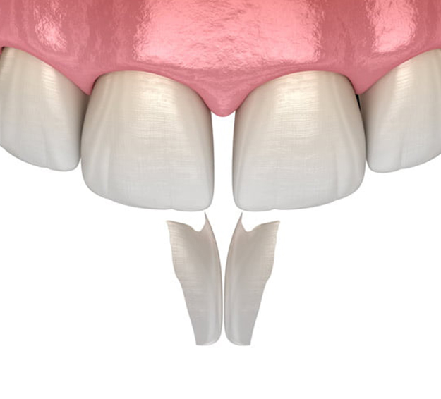 Dental veneers displayed on model teeth showing before and after cosmetic restoration results.