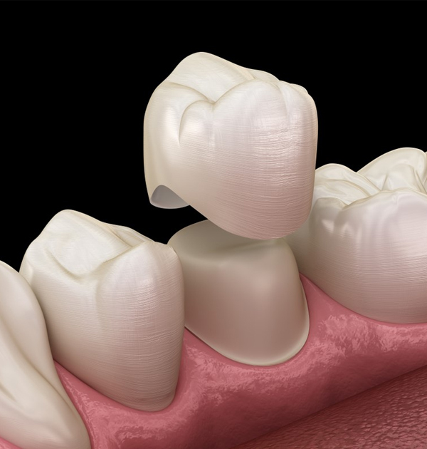 Dental crowns placed on tooth model showing prosthetic restoration procedure