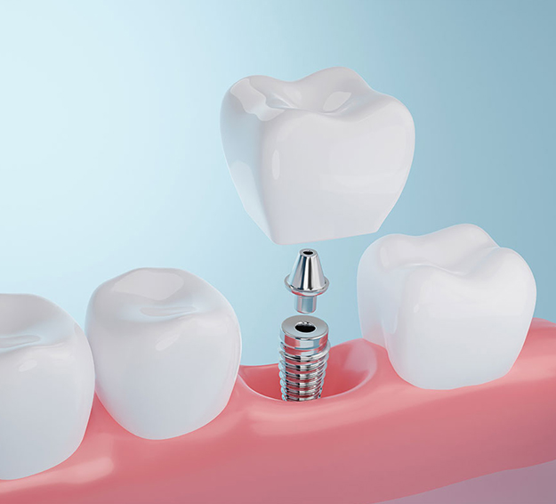 Henderson dental implants: Eat, speak, smile confidently again