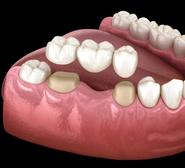 3D dental model showing tooth placement and gum structure for implant planning.