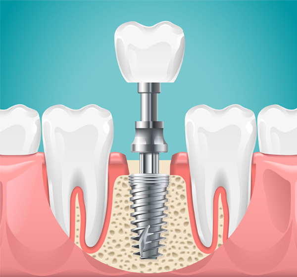 Missing teeth? Implants in Hendersn,NV offer permanent, confident smiles