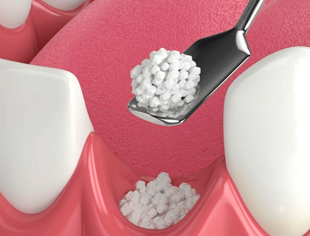 Dental model showing tooth extraction procedure with white teeth and bone graft material on pink background.