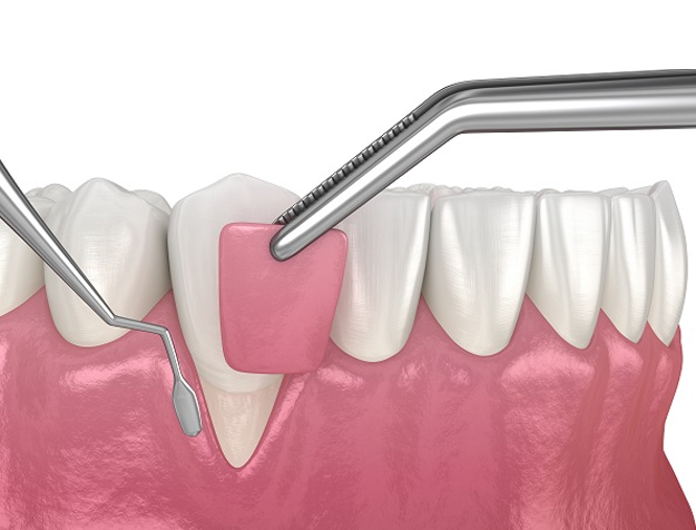 Dental scaling instrument removing tartar buildup from tooth and gum area during professional cleaning procedure.