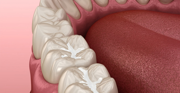 Close-up of white dental model teeth against pink background showing dental anatomy.
