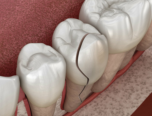 Dental model showing tooth anatomy with visible cracks and fracture lines on white teeth replicas.