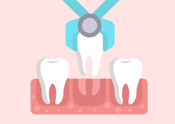 Dental implant procedure illustration showing tooth extraction tool and gum anatomy with surrounding teeth.