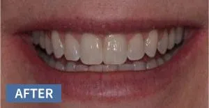 Close-up of a patient's smile showing whitened, evenly-spaced teeth after dental treatment.