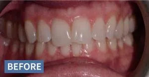 Before dental treatment showing crowded, misaligned teeth with visible plaque buildup