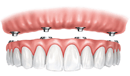Dental implant bridge model showing pink gum tissue above row of white artificial teeth.