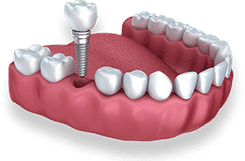 Dental implant model showing titanium screw, crown, and natural teeth in gum tissue.